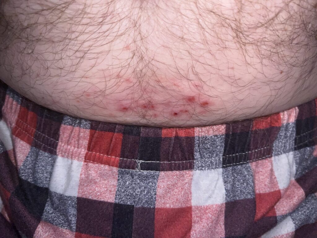 Stomach with rash at beltline